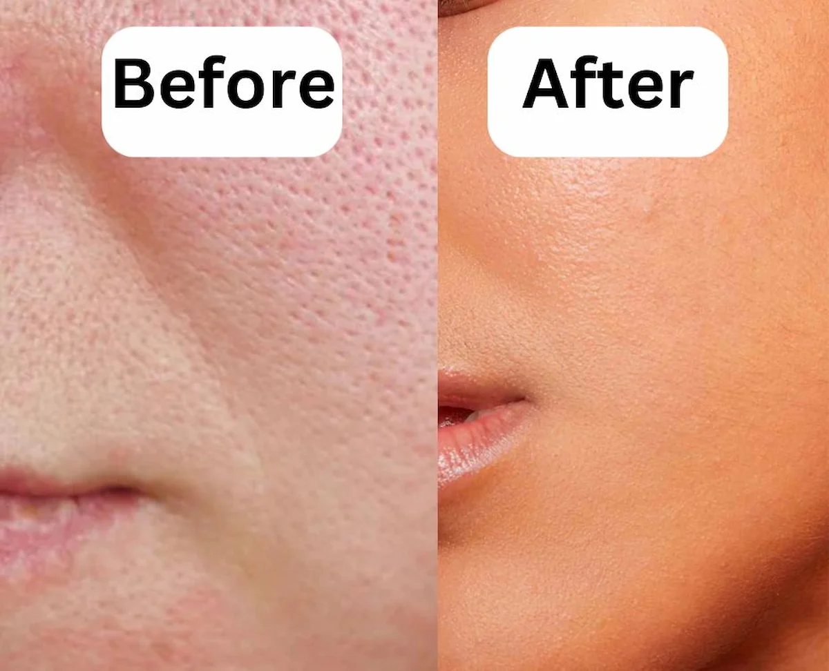 قبل و بعد درمان هایفو برای منافذ باز پوست